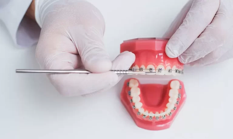 Planejamento ortodôntico. ortodontista mostra como é organizado o sistema de aparelho nos dentes