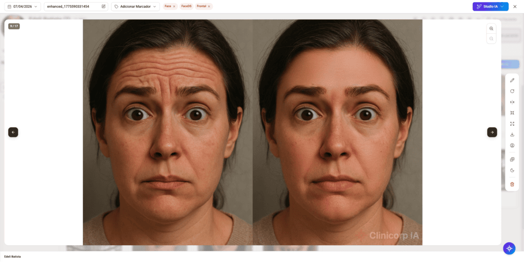 Imagem do Face Design Studio do Clinicorp, exibindo simulação de resultado de preenchimento facial antes e depois com base em foto real da paciente, recurso para gestão de procedimentos estéticos de preenchedores faciais.