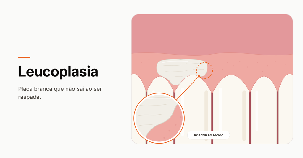 Ilustração da Leucoplasia na gengiva.