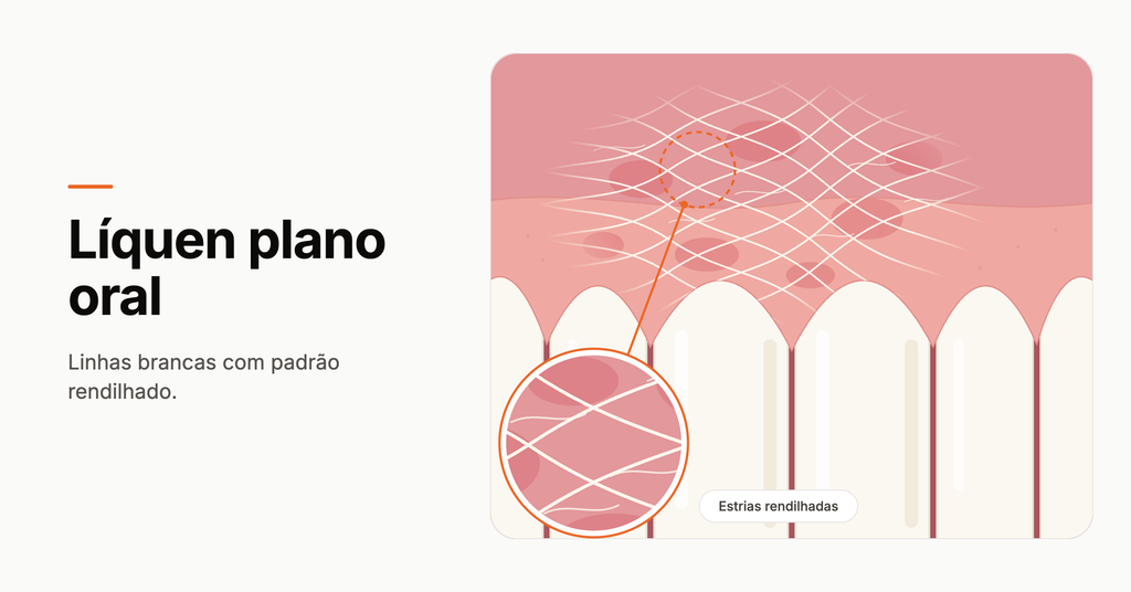 Ilustração do líquen plano oral.
