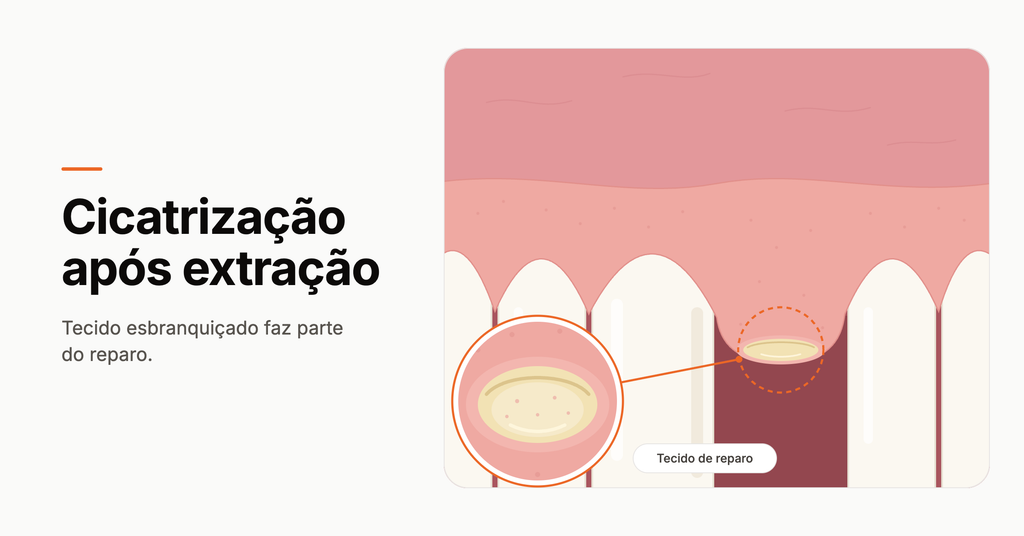 Ilustração da gengiva branca durante cicatrização após extração dentária.